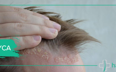 Łuszczyca skóry głowy – sprawdź co powinieneś wiedzieć!