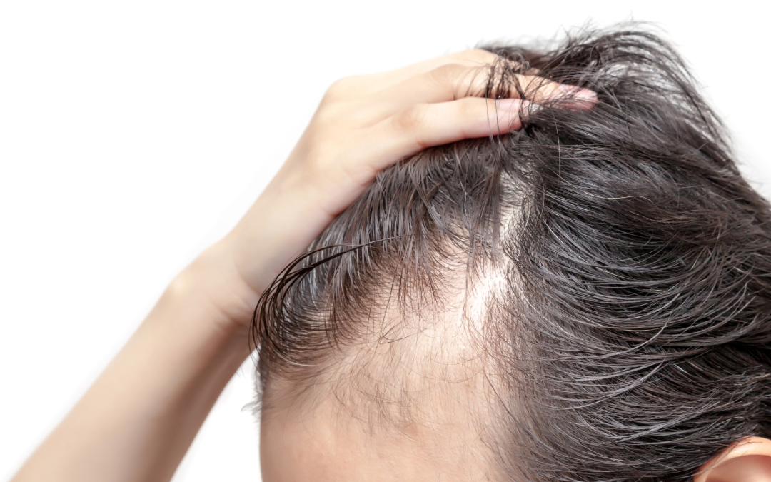 Hipotrichosis: włosy rzadsze niż normalnie – objawy, przyczyny, diagnoza